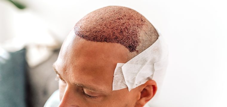 Best Hair Transplant in Bhopal