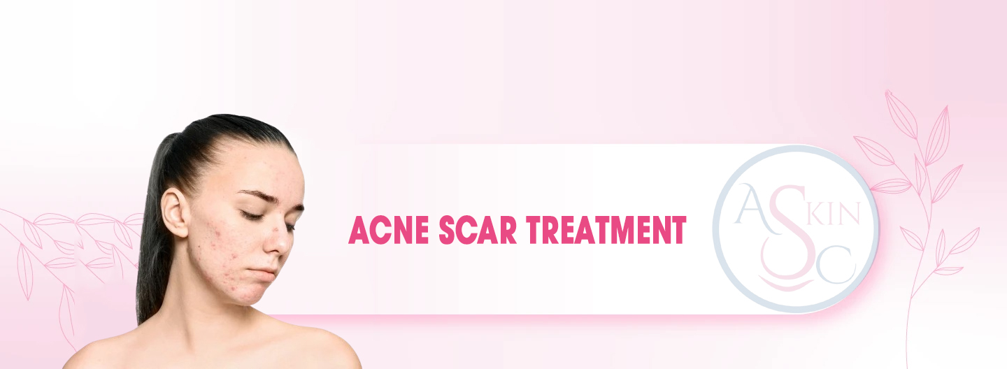 Acne Scar Treatment Bhopal