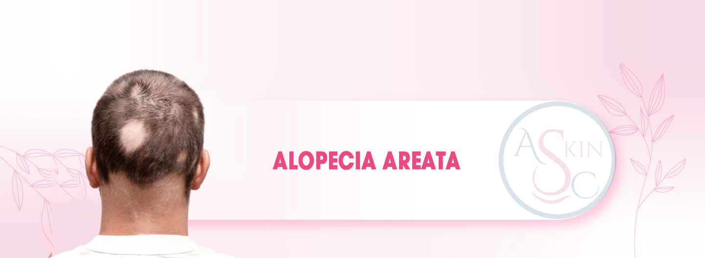 Alopecia Areata Treatment Bhopal