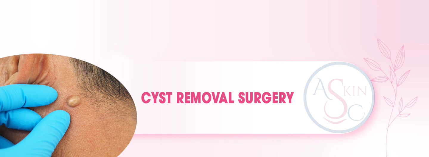 Cyst Removal Surgery in Bhopal