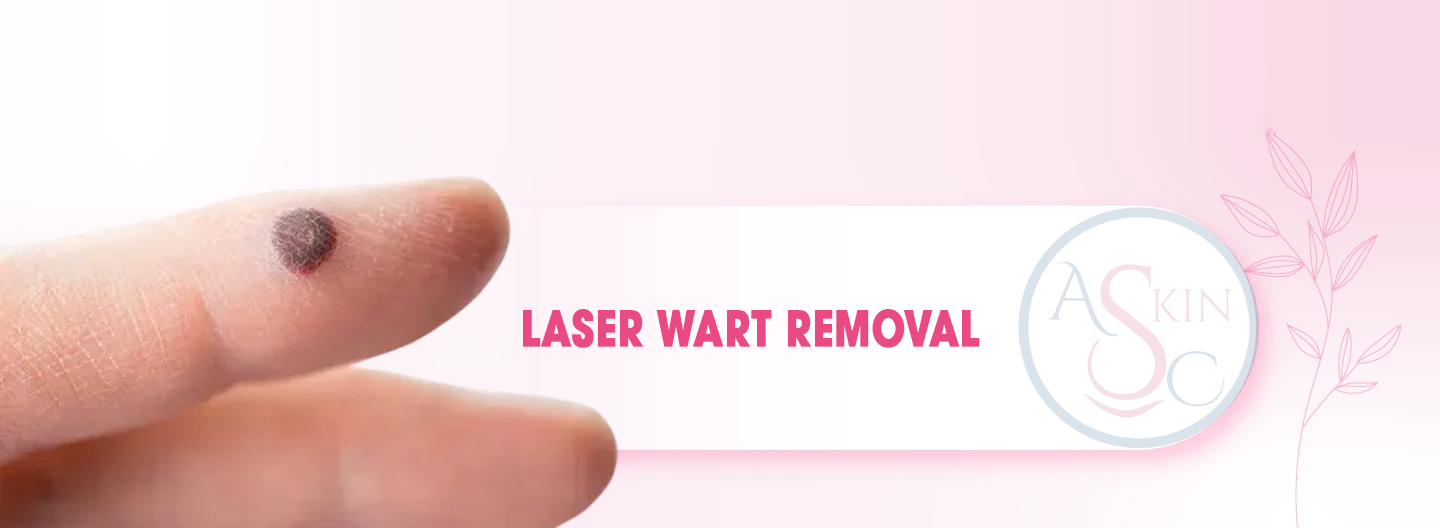 Laser Wart Removal Bhopal