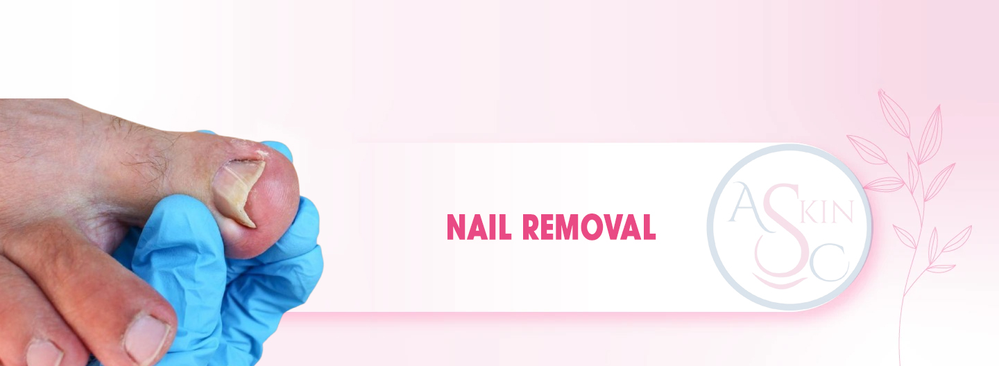 Nail Removal Surgery Bhopal