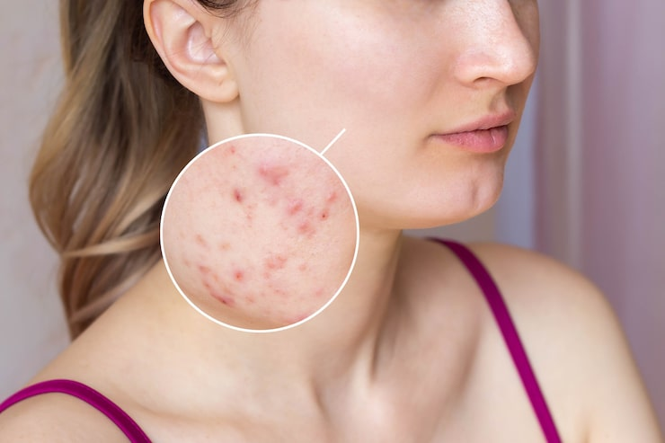 Acne Scars Treatment in Bhopal
