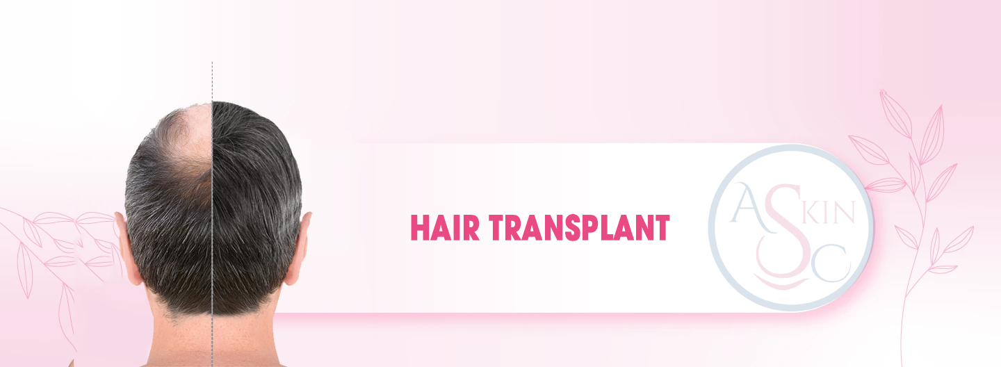 Best Hair Transplant in Bhopal