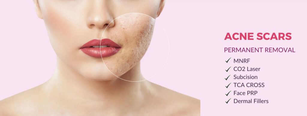 Acne Scars Treatment in Bhopal
