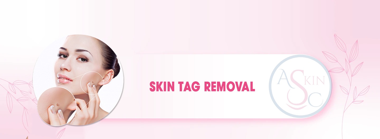 Skin Tags Treatment in Bhopal