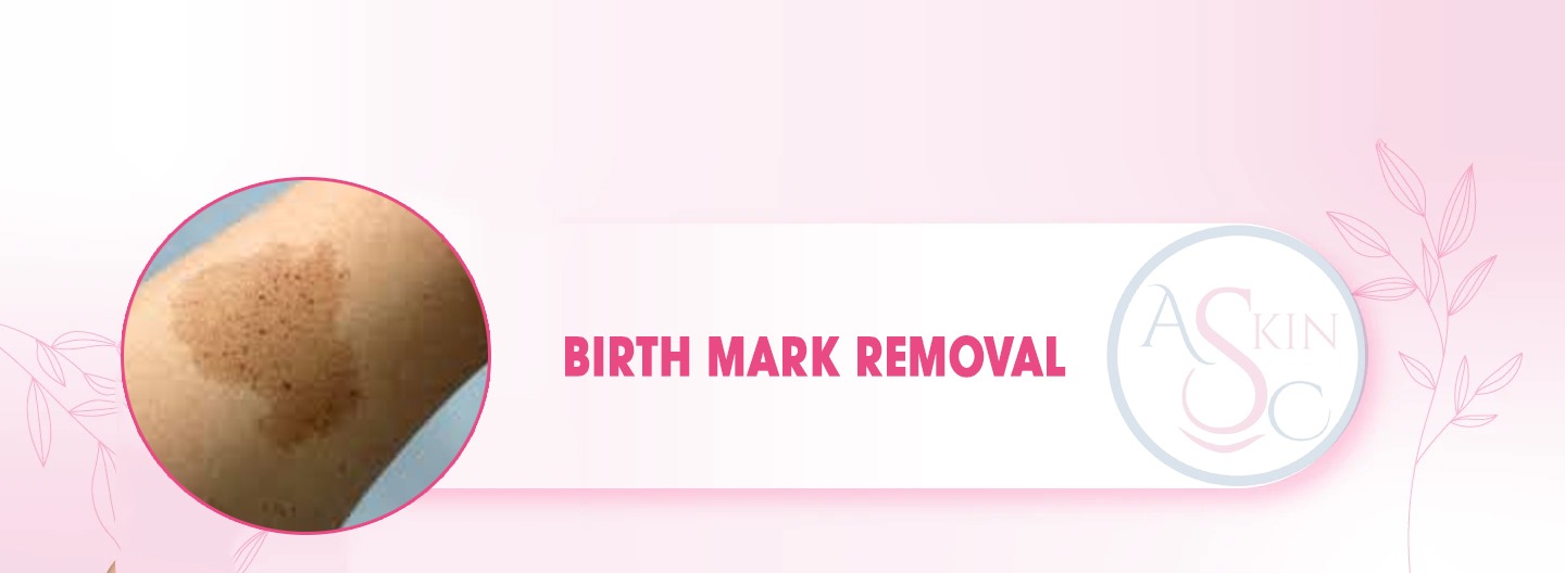 Birthmark Removal Treatment in Bhopal