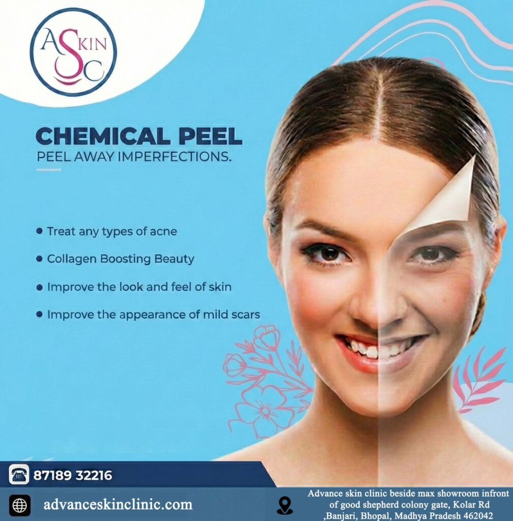 chemical peel treatment in Bhopal